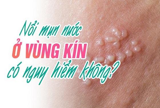 Vùng Kín Nổi Mụn Nước Là Triệu Chứng Bệnh Gì?